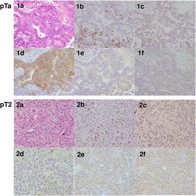 Clinicopathological Significance of Estrogen Receptor β and Estrogen Synthesizing/Metabolizing Enzymes in Urothelial Carcinoma of Urinary Bladder